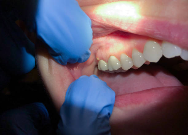 Best Emergency Dental Care for Sports Injuries in Middletown, CA